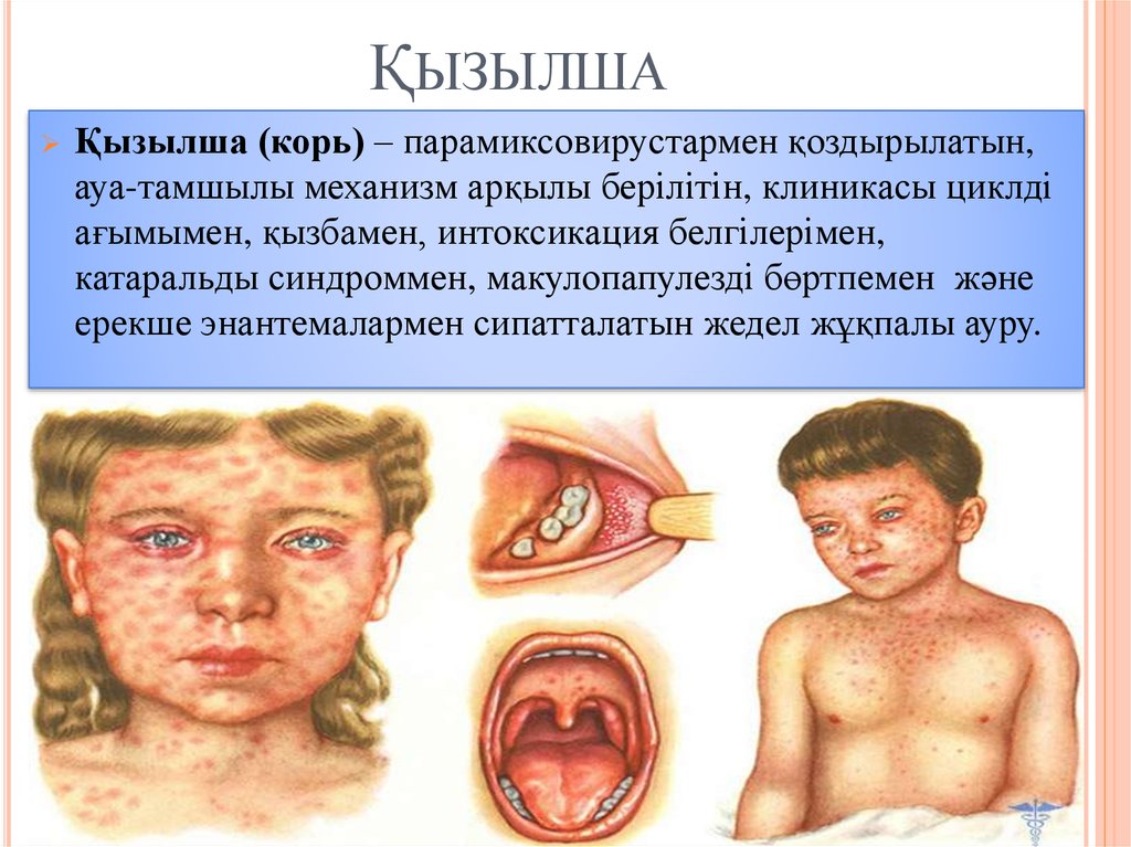Қызылша жұқпалы ауруы туралы ақпарат